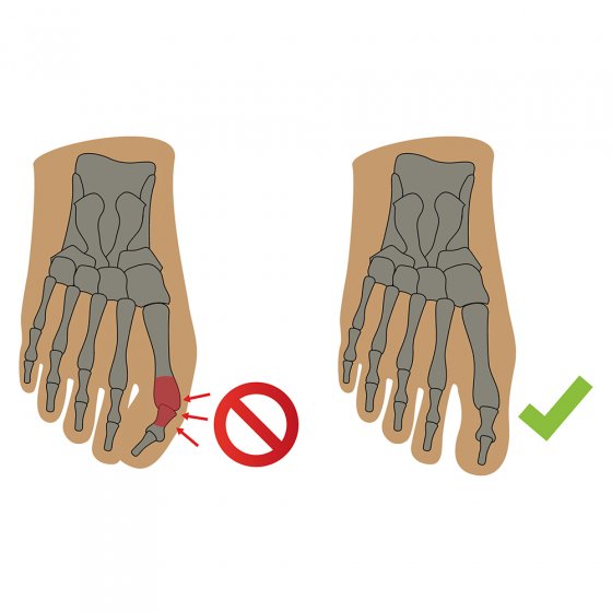 Hallux valgus nachtbandage 