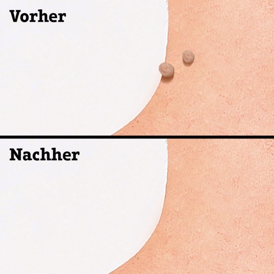 Wratten-verwijderpads Wratten-verwijderpads