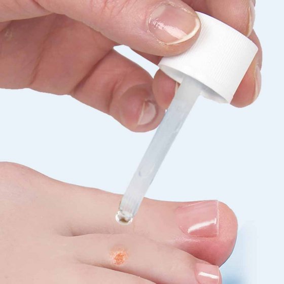  ‘Vaarwel wratten’-tinctuur 