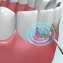 'Dental Pic Sonic'-tandenreiniger - 4