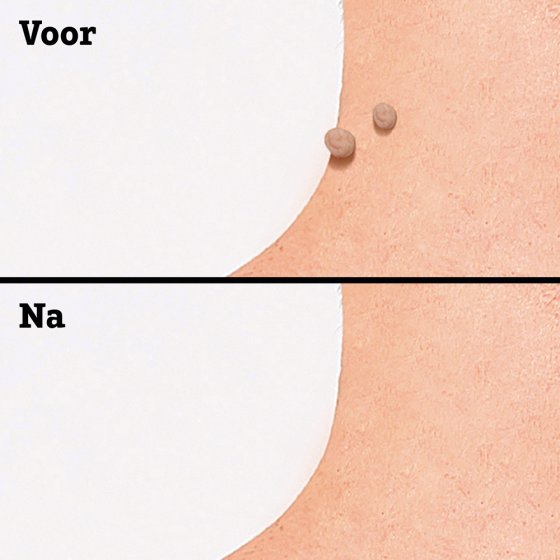 Wratten-verwijderpads