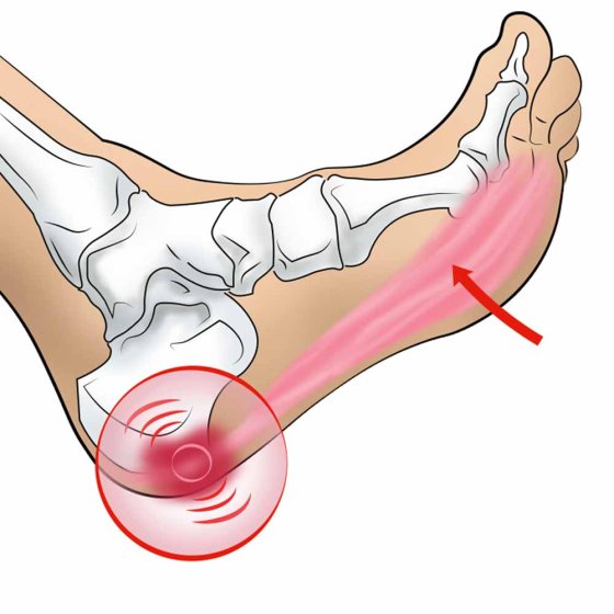 Fascia-voetroller 