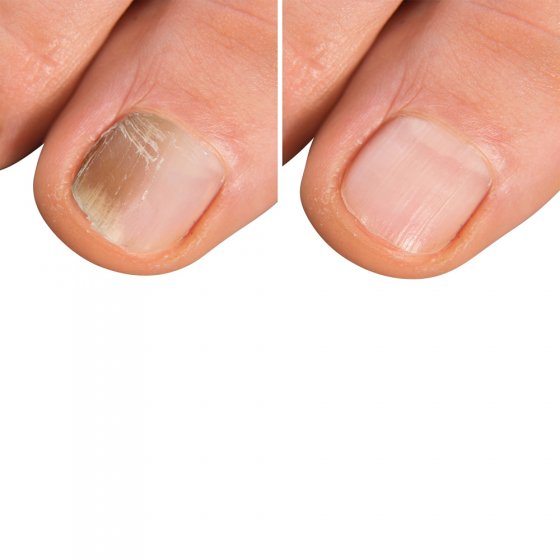 Voet- en nagelschimmelspray 